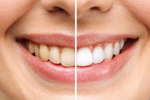 Före och efterbild tänder