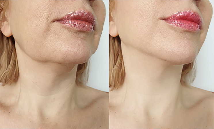 before/after image double chin side by side