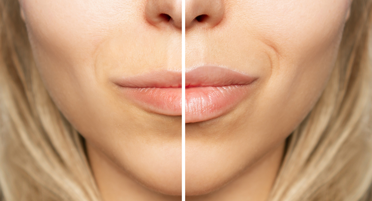 Before and after image example – Lips