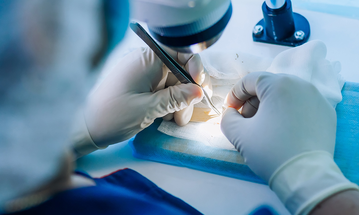 Close-up of a hair transplant procedure — precision and documentation in a clinical setting